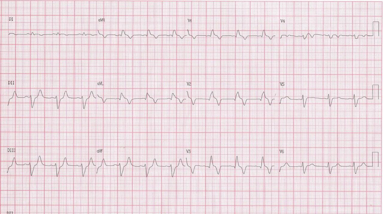Paciente masculino de 54 años con episodio de angor prolongado debido a SCA por oclusión total de la DA y nacimiento anómalo de la Cx en el seno coronario derecho de la CD
