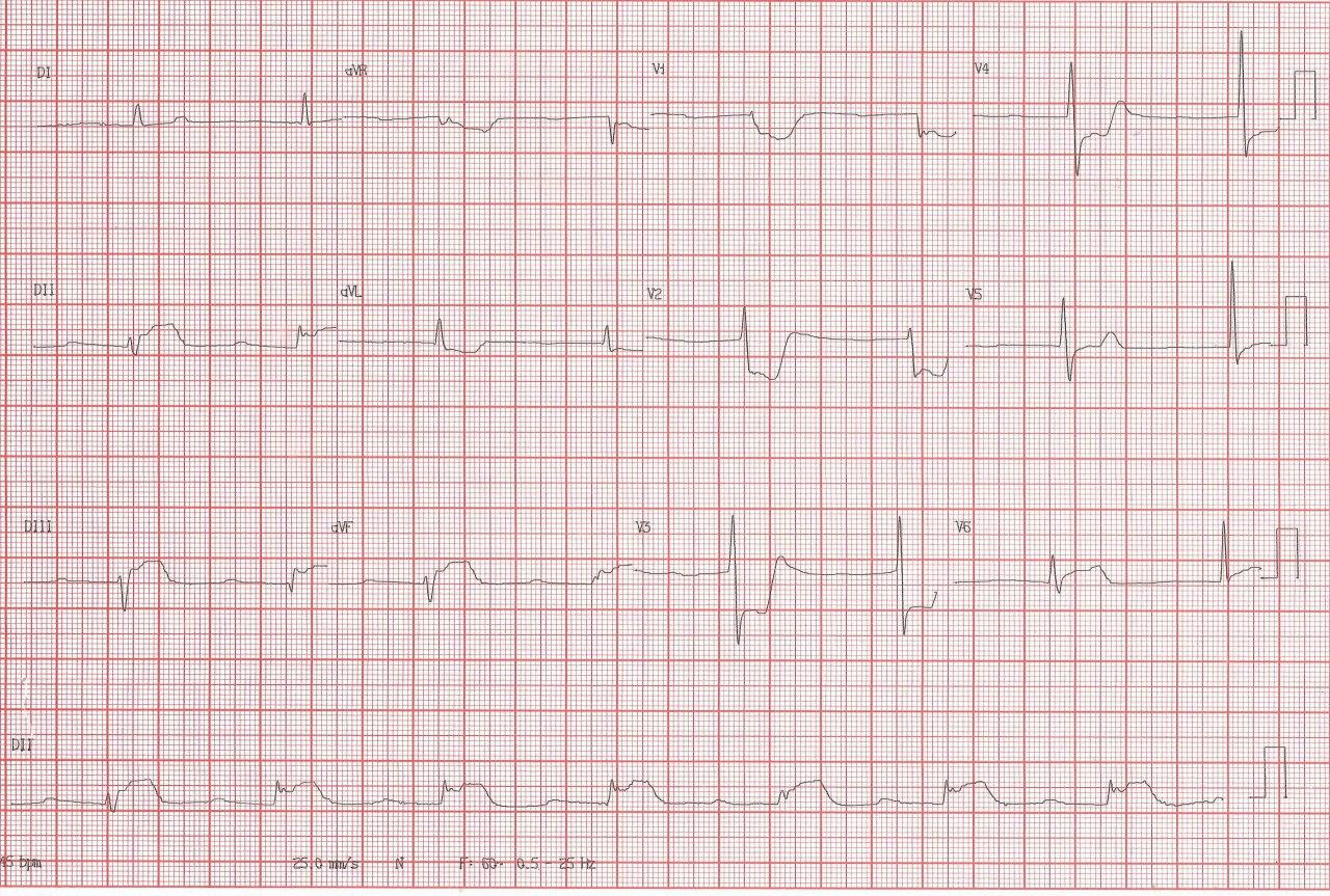 Hombre de 83 años cursando SCA con ritmo de la unión por compromiso de la arteria del nódulo AV en este caso ramo de la arteria Cx, con recuperación post angioplastia