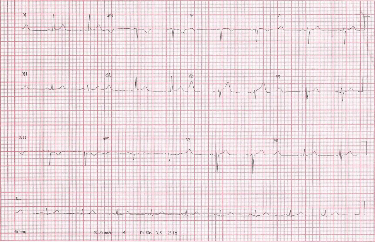 Hombre de 54 años hipertenso y diabético que presenta angor prolongado cuyo ECG presenta signos de isquemia grado I debidos a oclusión de DA