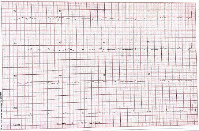 Mujer de 57 años con disnea progresiva y edemas en MMII que cursa con severo derrame pericárdico