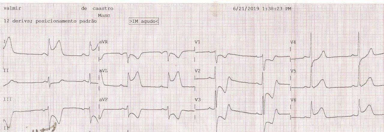 ECG correspondiente a paciente cursando SCA por compromiso de la CD, con inversión de cables del hemicuerpo izquierdo