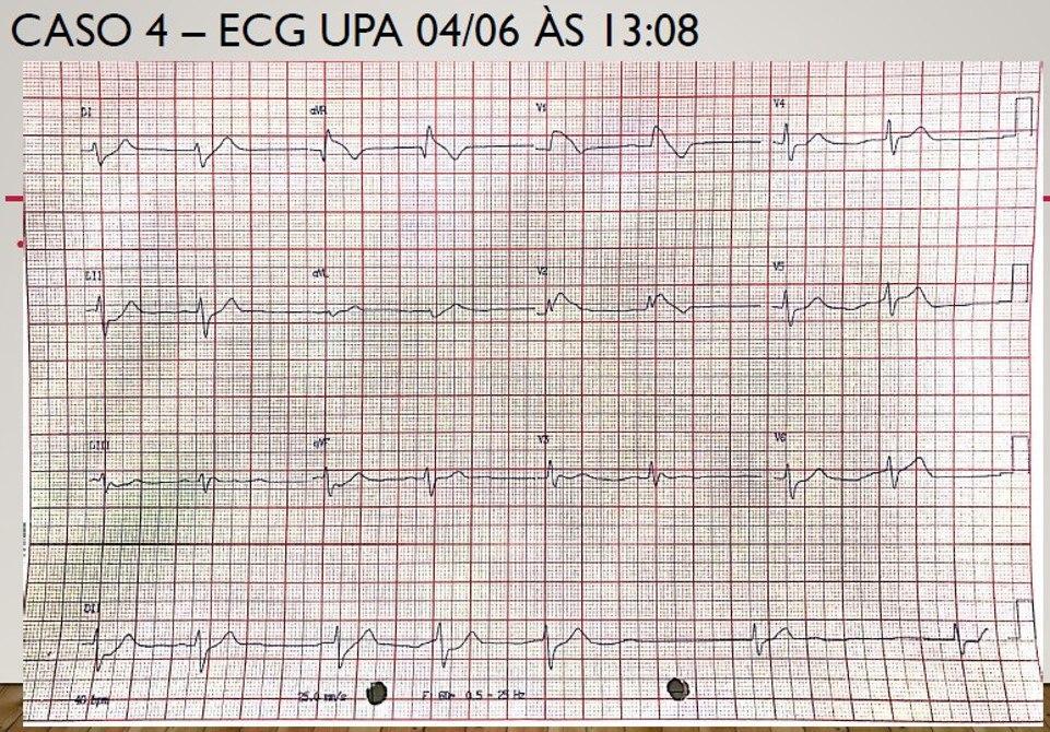 Mujer de 20 años con intento de suicidio con numerosos comprimidos de atenolol que presenta ritmo de la unión y desenmascaramiento de síndrome de Brugada con ulterior infección respiratoria post intubación traqueal