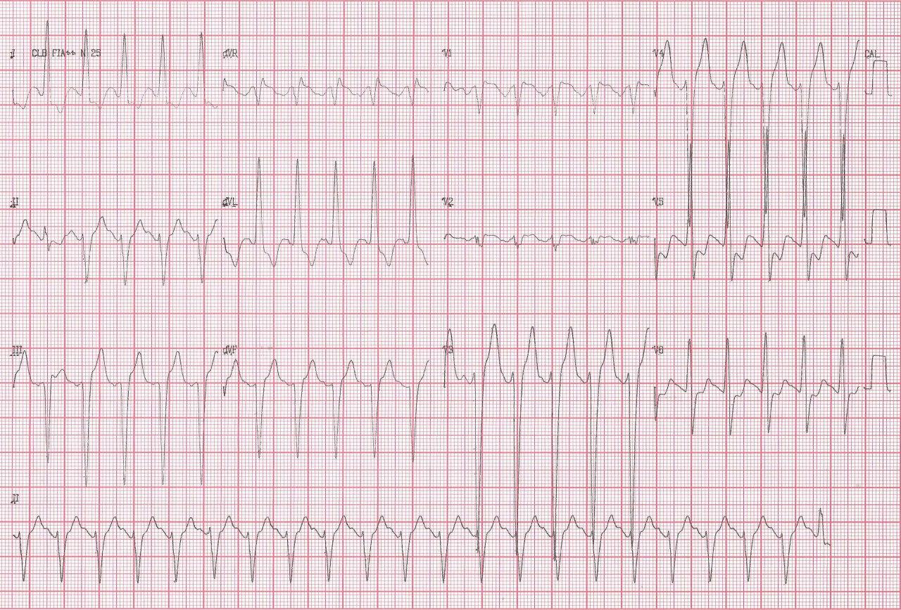 Hombre de 48 años portador de insuficiencia aórtica y mitral que presenta síncope atribuible a TV polimórfica de origen isquémico