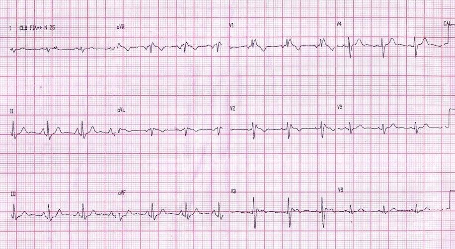 Hombre de 32 años con gran delgadez con antecedente de episodios sincopales que presenta síndrome de Brugada