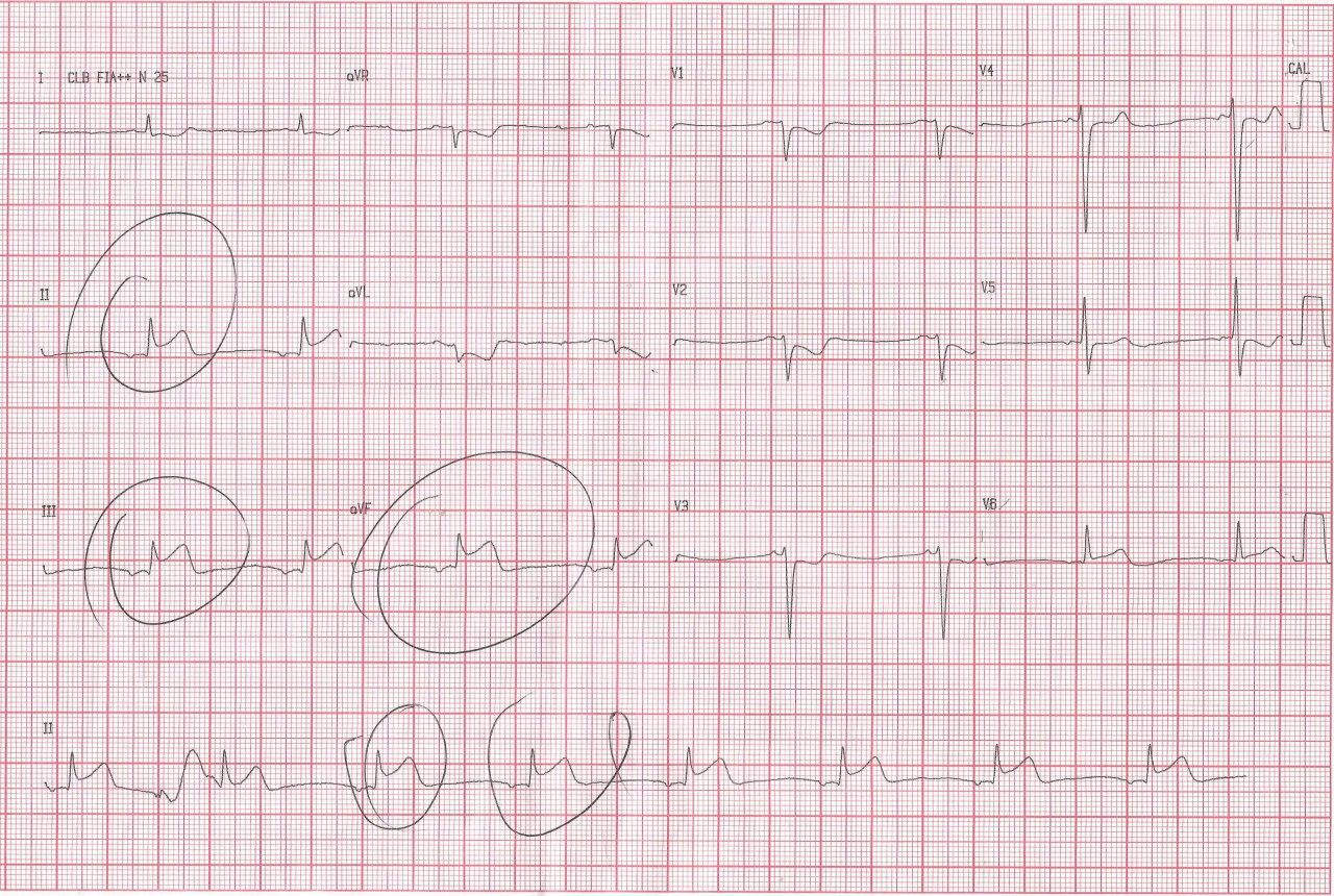 Hombre de 67 años que presenta SCA por compromiso de CD y ritmo auricular ectópico