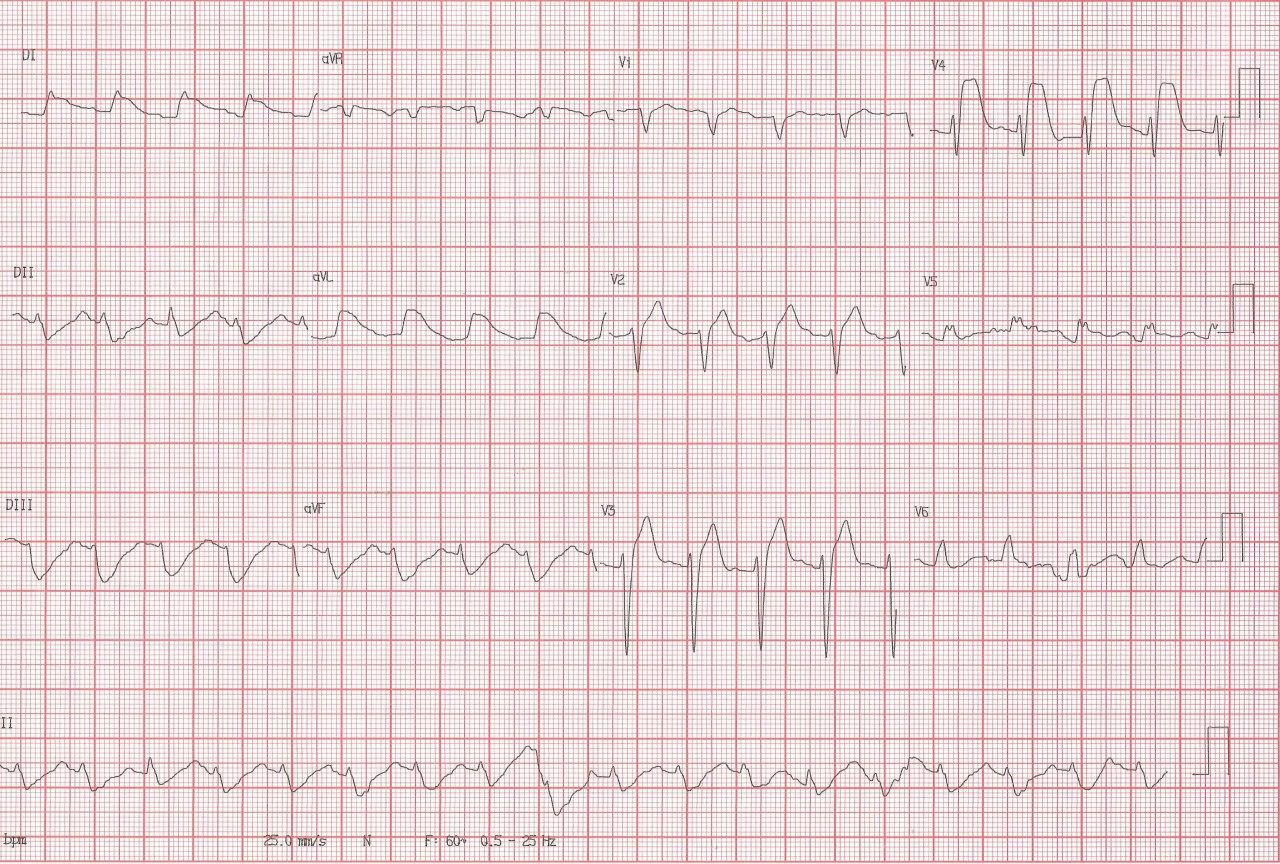 Paciente de 35 años con antecedente inmediato de reemplazo valvular aórtico que suspende tratamiento anticoagulante presentando síncope y FV por embolia coronaria a la DA