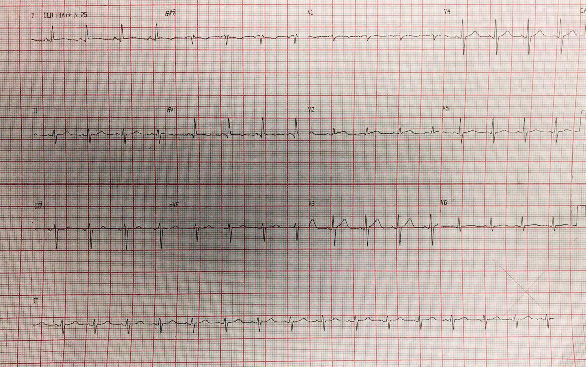 Hombre de raza negra de 45 años, hipertenso, consumidor de cocaína que presenta intenso dolor precordial por disección aórtica tipo A