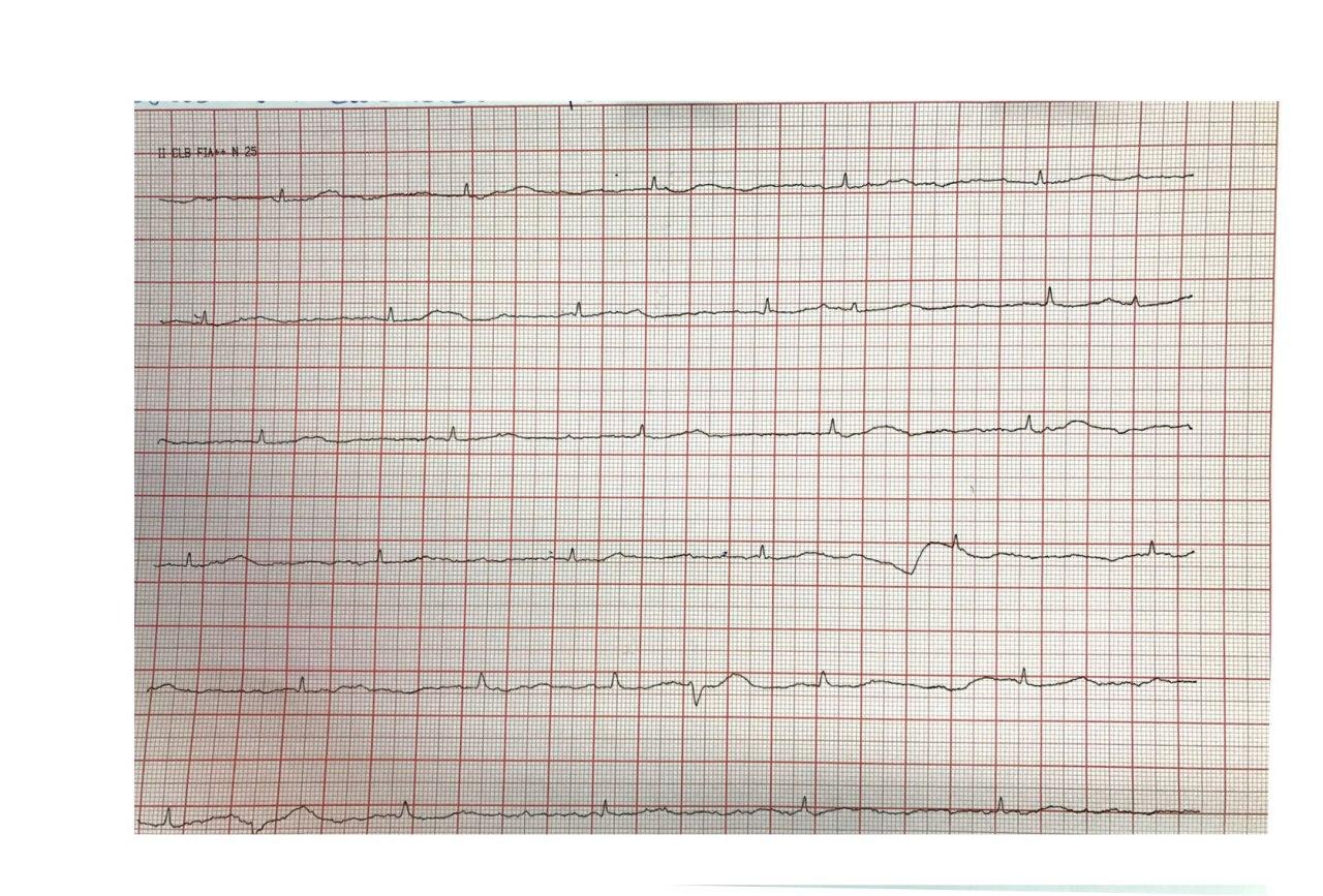 Mujer con factores de riesgo que presenta episodio sincopal que requiere implante de MP transitorio con desplazamiento posterior del electrodo y falla de captura y presencia de ondas T electromoduladas con arterias coronarias sin lesiones significativas