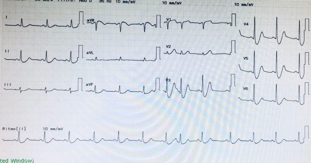 Paciente que cursa SCA por oclusión de la DA cuyo ECG presenta el denominado patrón de Winter, previamente descripto por Sclarovsky
