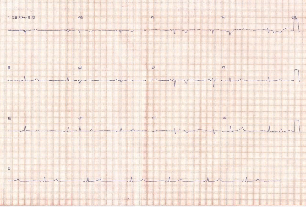 Mujer de 56 años que consulta por calambras y parestesias, con antecedente de tiroidectomía por CA de tiroides que cursa con severa hipocalcemia por hipoparatitoidismo