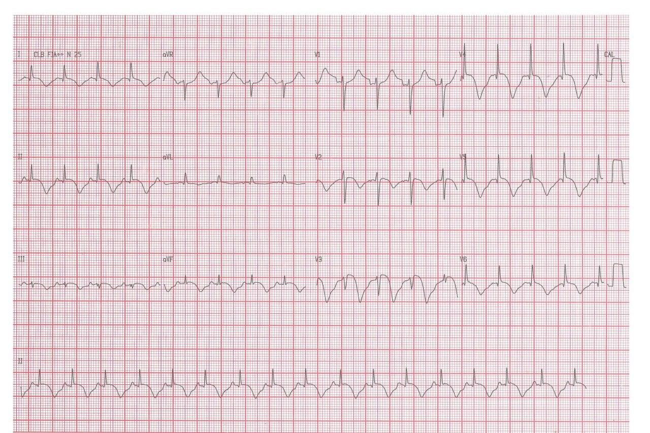 Hombre de 61 años que durante broncoscopía para descarte de CA pulmonar desarrolla intenso broncoespasmo, precordialgia y discreta elevación de troponina, constatándose coronarias normales e hipocinecia apical que empeora con salbutamol, sospechándose síndrome de Takotsubo