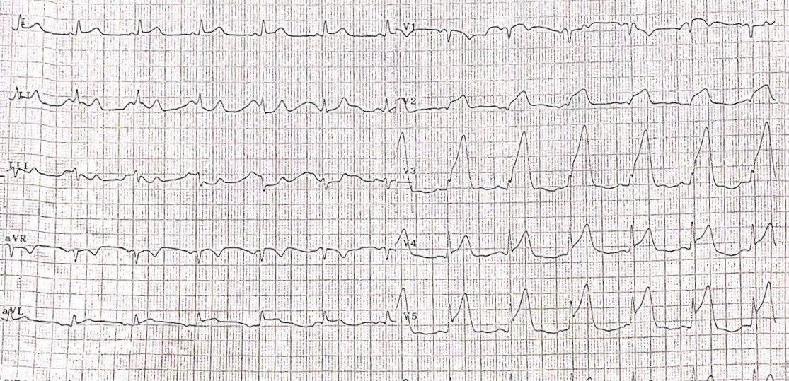 Paciente de 51 años con angor prolongado que presenta un SCA por compromiso de la DA con trombo y que en un segundo ECG presenta RIVA indicando reperfusión