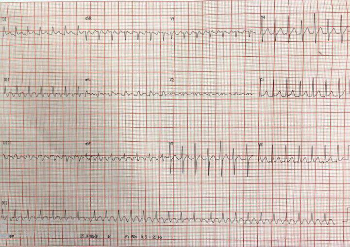Mujer de 44 años que refiere palpitaciones por presencia de aleteo auricular 2:1 secundario a la presencia de mixoma auricular izquierdo