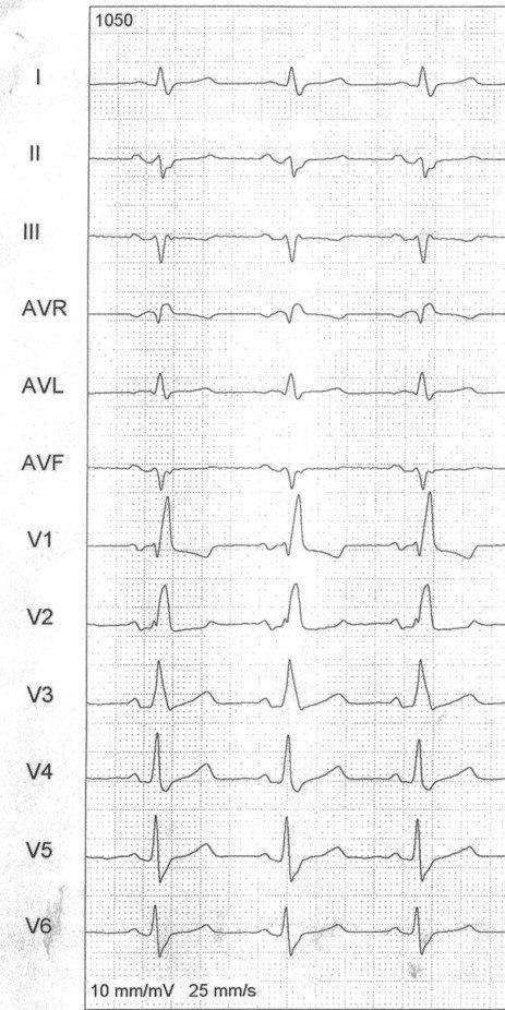 Paciente masculino de 51 años con palpitaciones recurrentes con sospecha de presencia de vía anómala que es desenmascarada con la infusión de adenosina