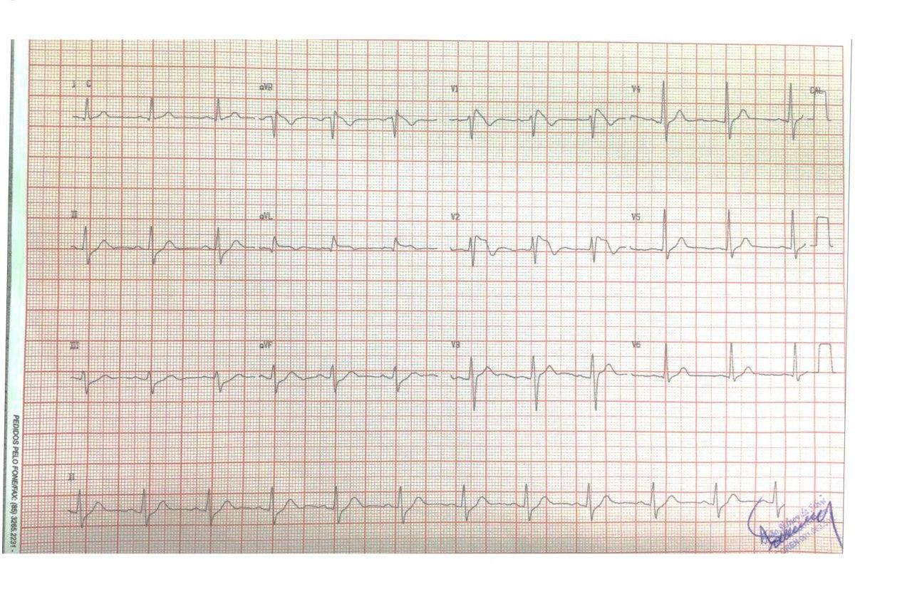 Hombre de 38 años con antecedentes familiares de MS cuyo ECG preoperatorio de rinoplastia muestra un patrón Brugada tipo I