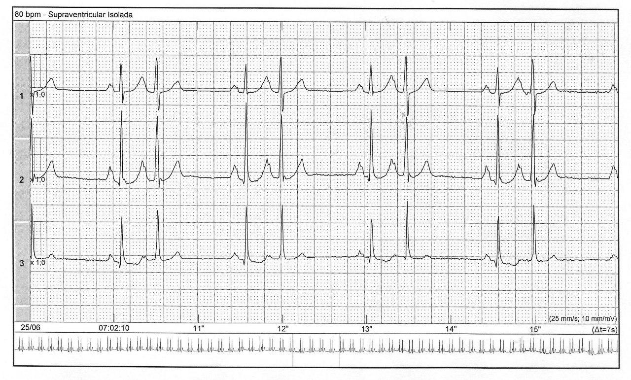 Mujer de 63 años con palpitaciones por extrasistolia auricular bigeminada con ondas P´ sobre la rama descendente de Ta previa, signo predictor de FA