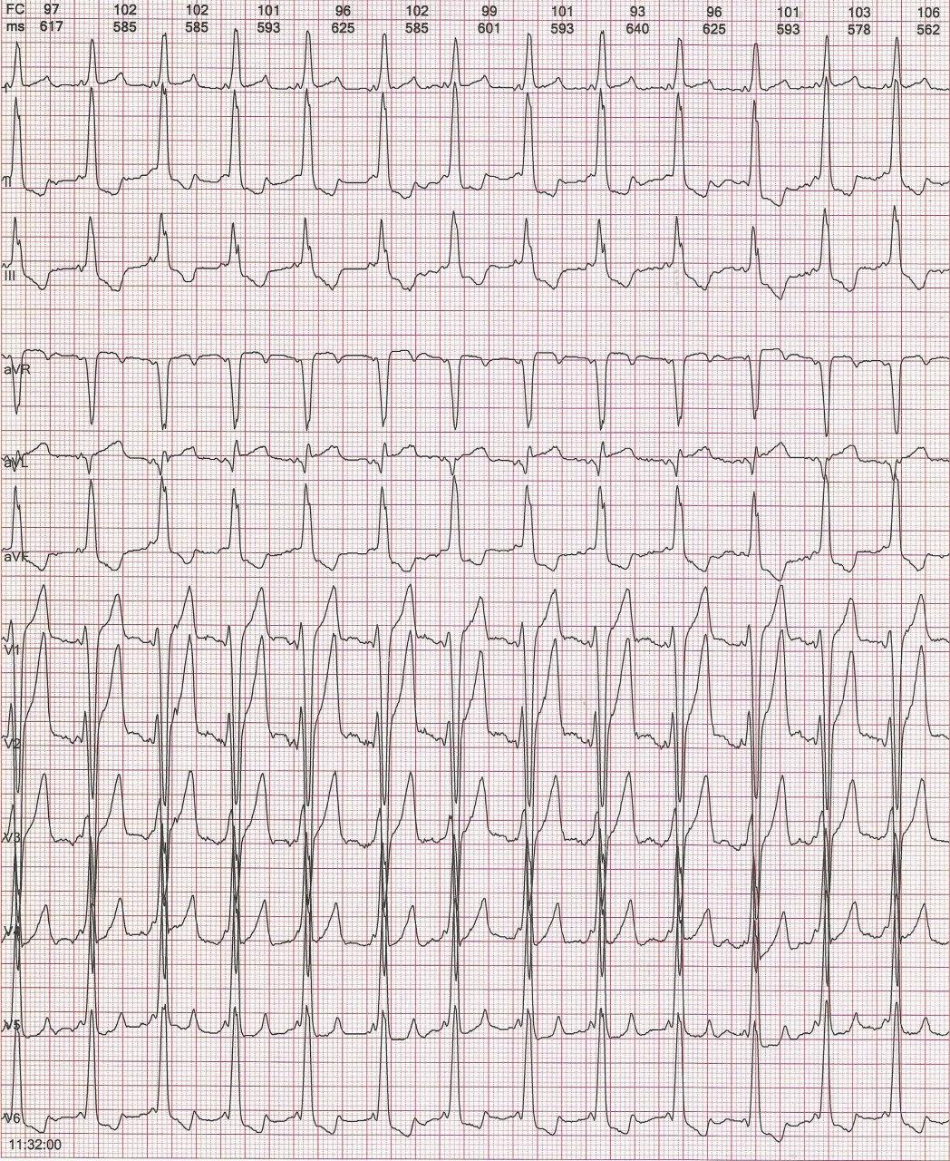 Niño de 6 años que refiere palpitaciones por ocurrencia de una TRAVO en el contexto de síndrome de WPW