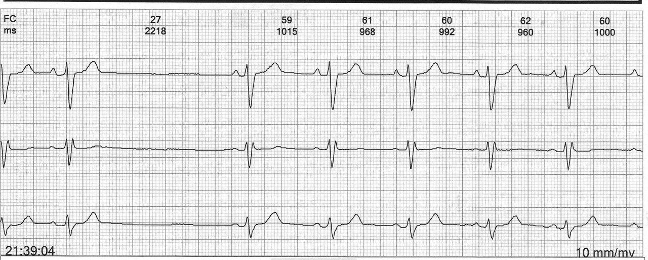 Mujer de 81 años con palpitaciones y mareos con bloqueo sinoauricular de 2º grado tipo II constituyendo una enfermedad del nódulo sinoauricular