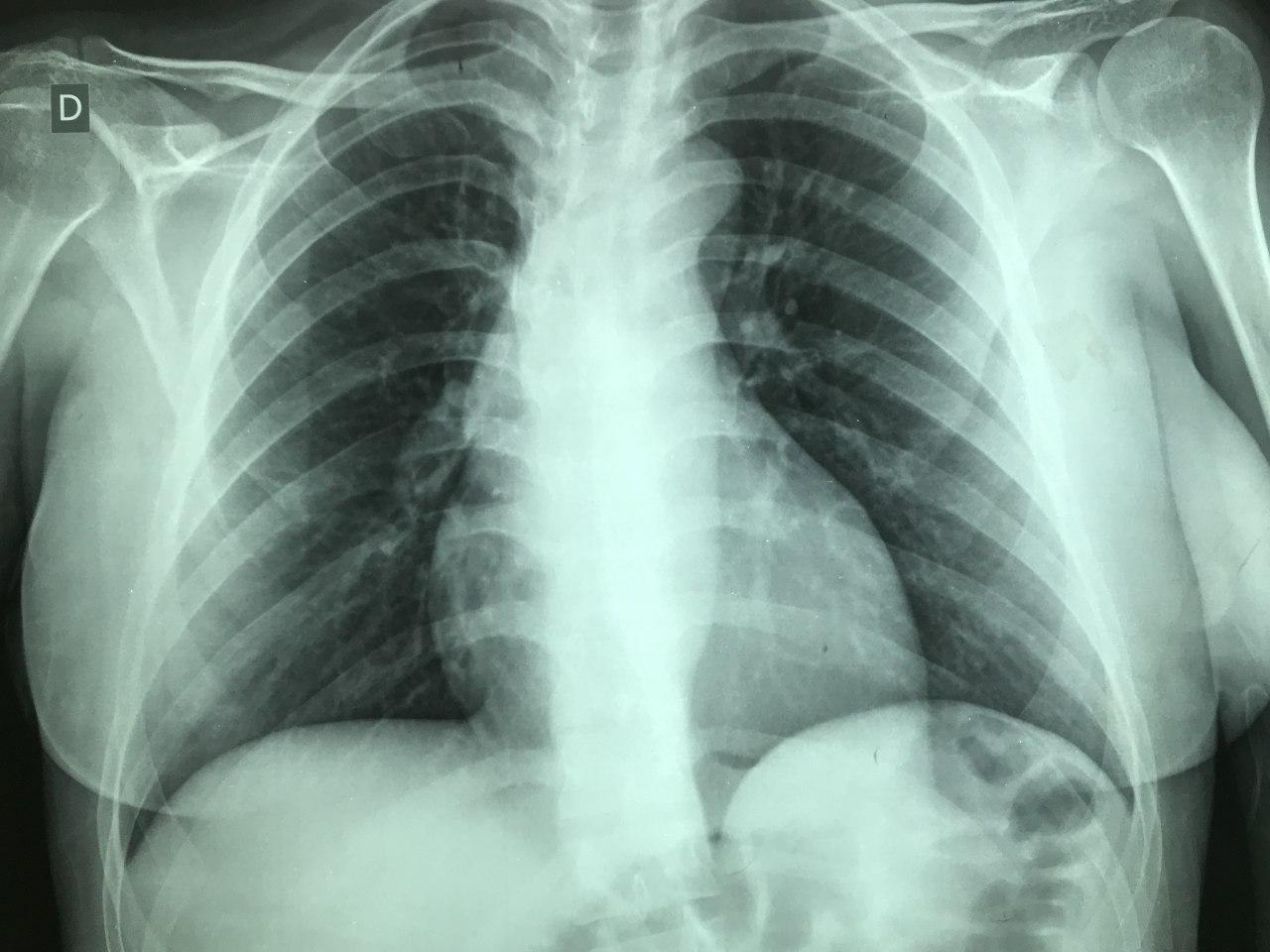 Mujer de 24 años portadora de síndrome de Marfan que cursa embarazo de 37 semanas que presenta disección aórtica tipo A en porción ascendente