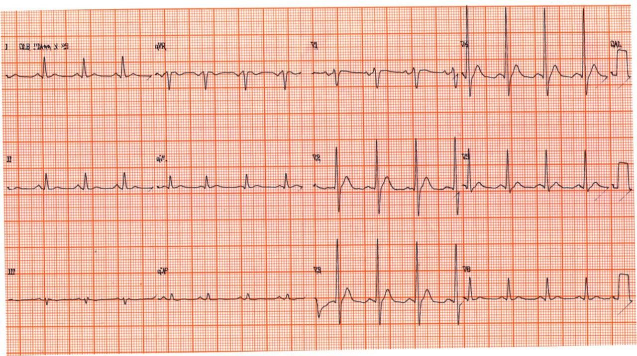 Paciente de 71 años portador de Ca de próstata con metástasis óseas e hipernefroma que presenta ECG con QT corto debido a franca hipercalcemia