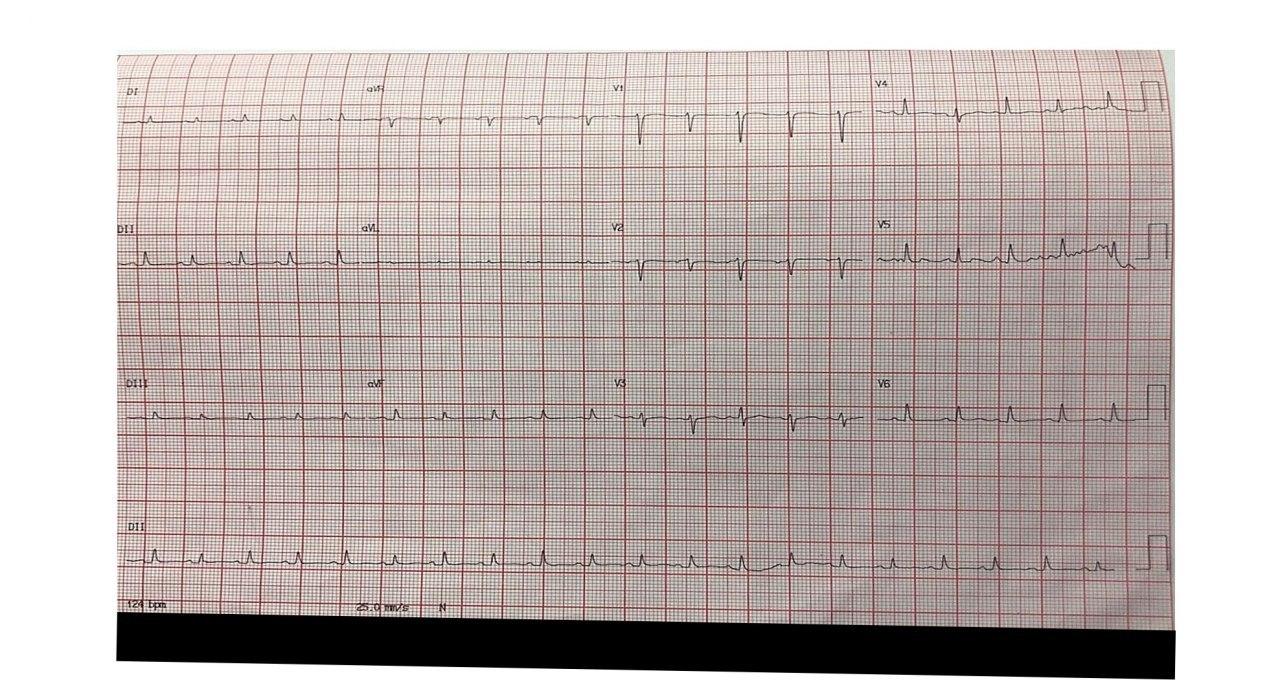 Masculino de 20 años que presenta dolor precordial de tipo pericardítico con disnea progresiva y fiebre que presenta severo derrame pericárdico sero hemorrágico por linfoma