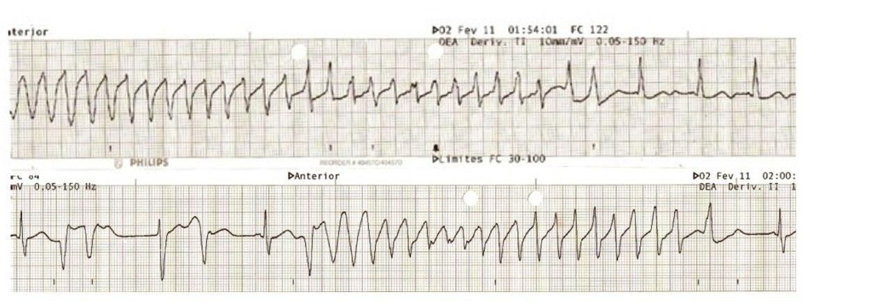 Paciente de 73 años que cursa con infección urinaria tratada con norfloxacina que al  cabo de 72 hs presenta episodios sincopales por desarrollo de QTc largo y TV polimorfa con T de P