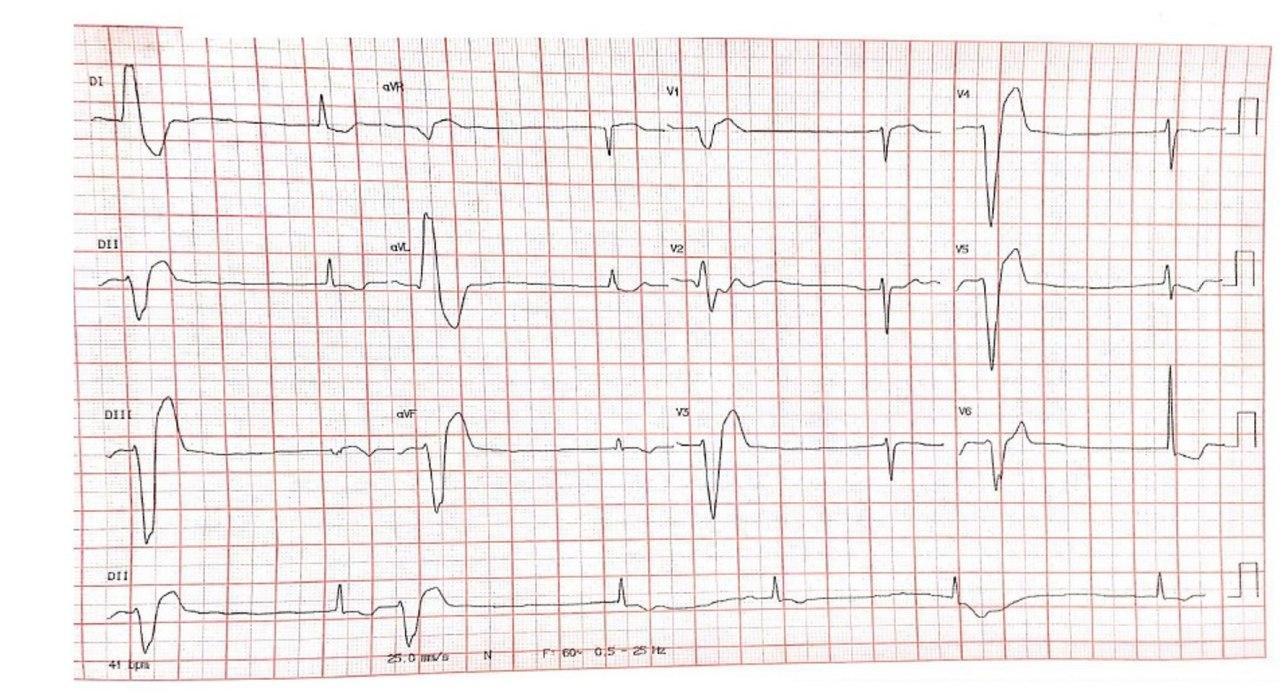 Mujer de 43 años con IRC dialítica, digitalizada por FA crónica que desarrolla ritmo nodal activo por intoxicación digitálica