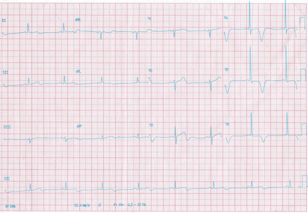 Mujer de 77 años con precordialgia atípica portadora de miocardiopatía hipertrófica apical cuyo ECG simula un síndrome de Wellens