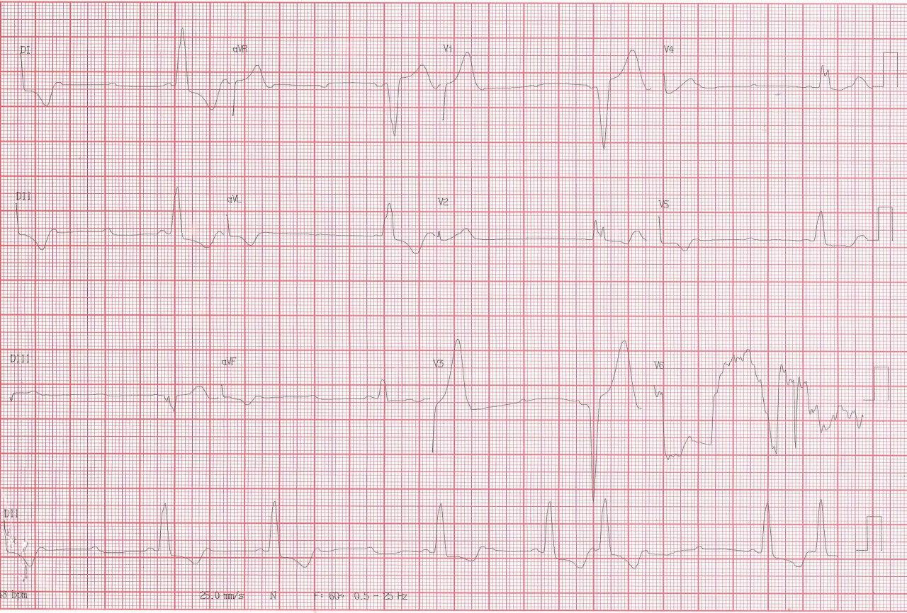 Hombre de 78 años que presenta episodio sincopal por presencia de Bloqueo AV de segundo grado tipo Mobitz II, con periodicidades variables