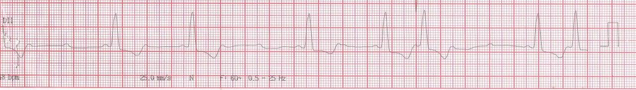 Mujer de 51 años con palpitaciones por presentar TRIN lenta-rápida
