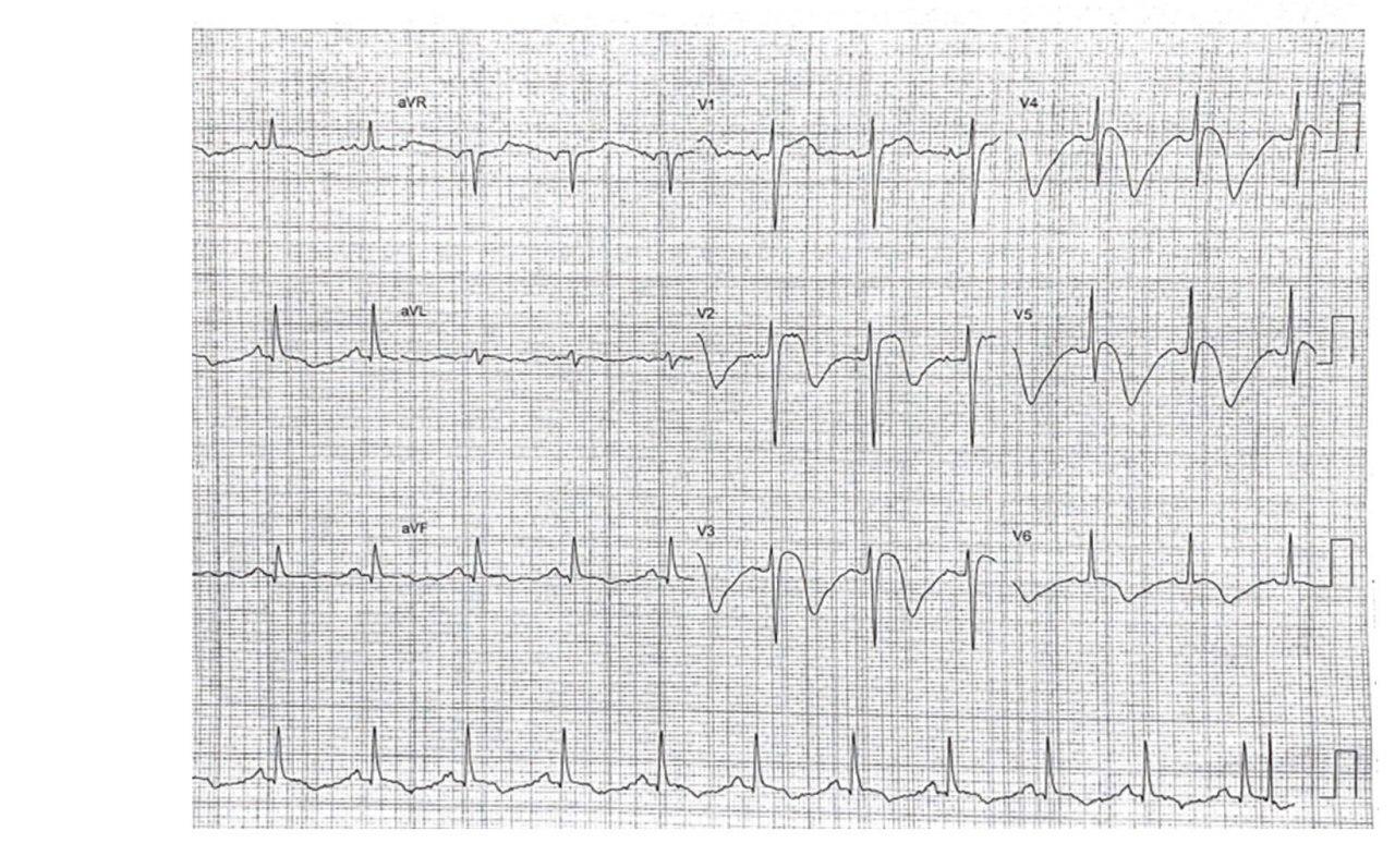 Mujer de 73 años con epigastralgia, náuseas y vómitos con troponina positiva, e hipocinesia moderada en la zona apical con arterias coronarias normales debidos a miocardiopatía de TakoTsubo