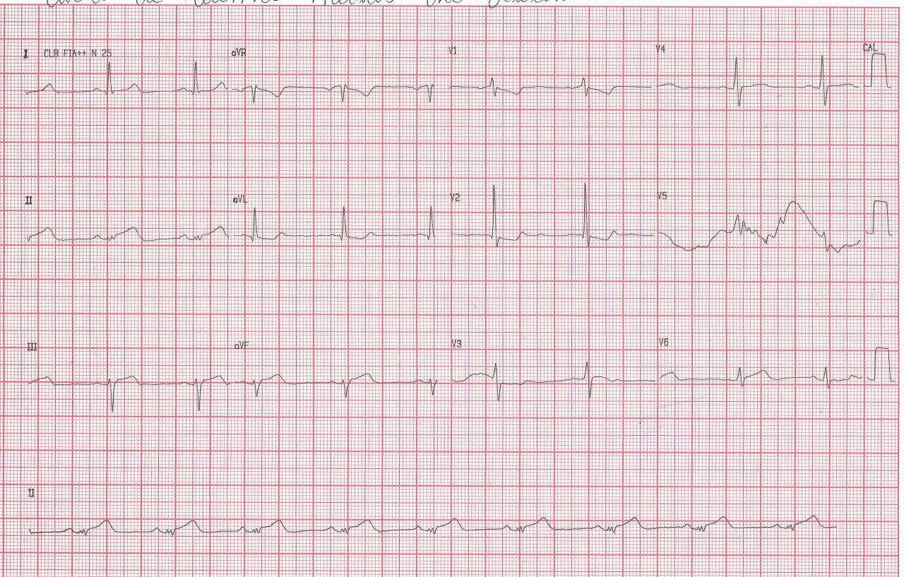 ECG de paciente que cursa SCA con sobreelevación de ST DII > DIII lo que indica que la arteria culpable es la Cx