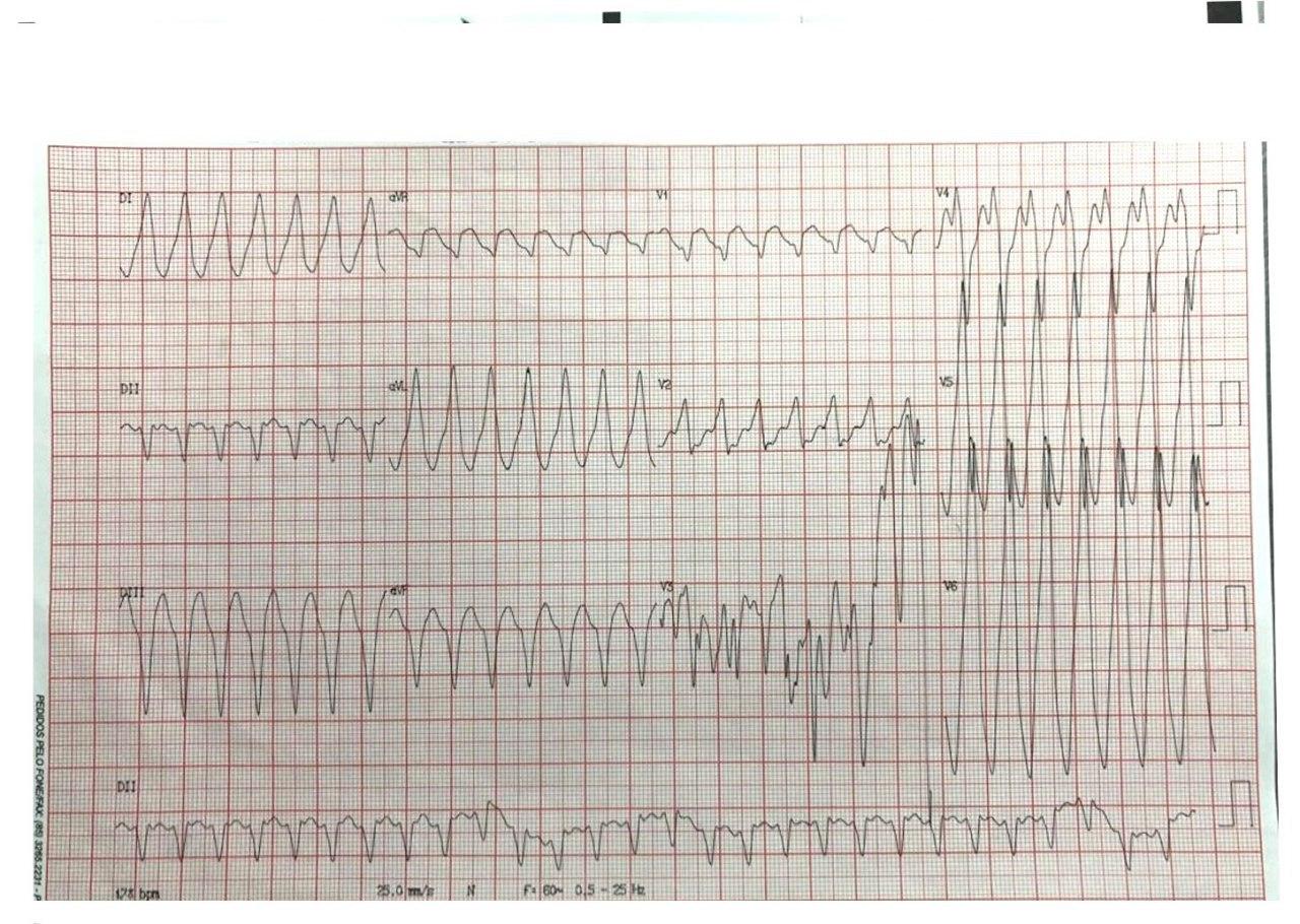 Hombre de 63 años con dolor epigástrico que presenta TV en contexto de infarto crónico de cara inferior