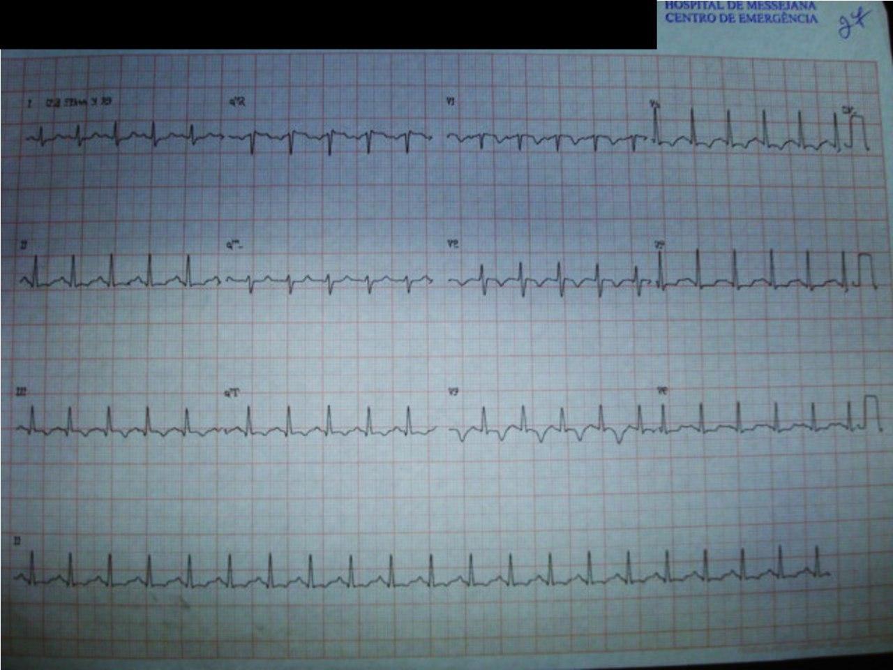 Mujer de 71 años que presenta disnea súbita y desasosiego por tromboembolismo pulmonar, con S1Q3T3 con presencia de trombo en silla de montar