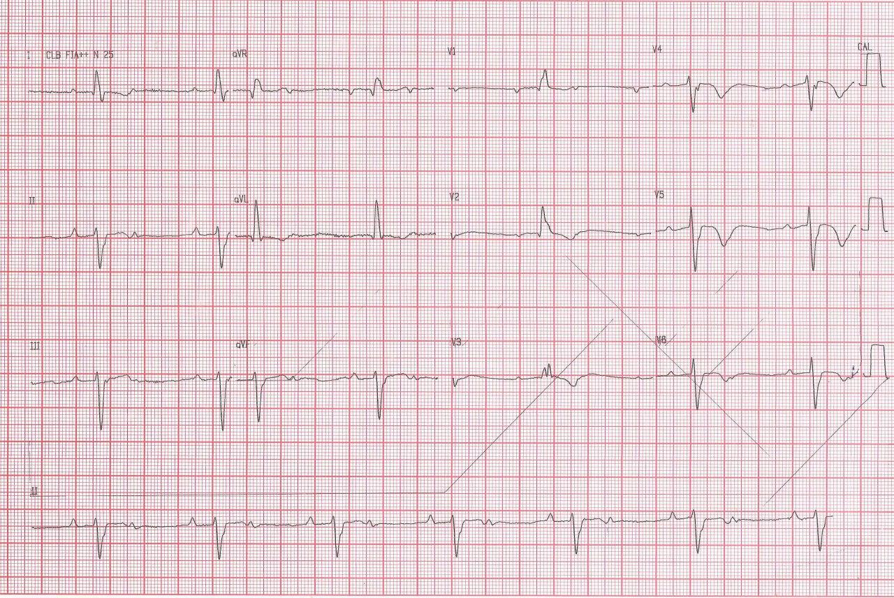 Hombre de 75 años que presenta episodio sincopal por presentar bloqueo trifascicular