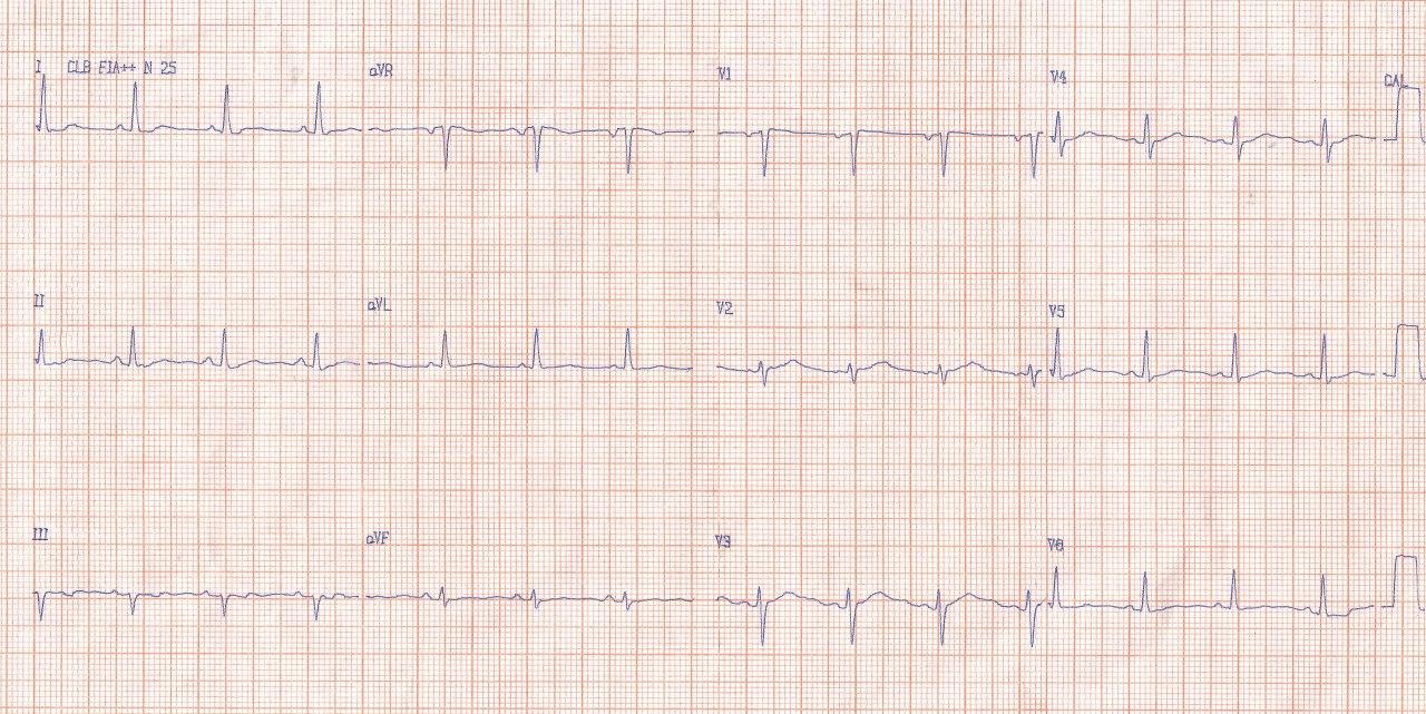 Mujer de 33 años sin cardiopatía estructural, recuperada de FV que presenta SQTL congénito