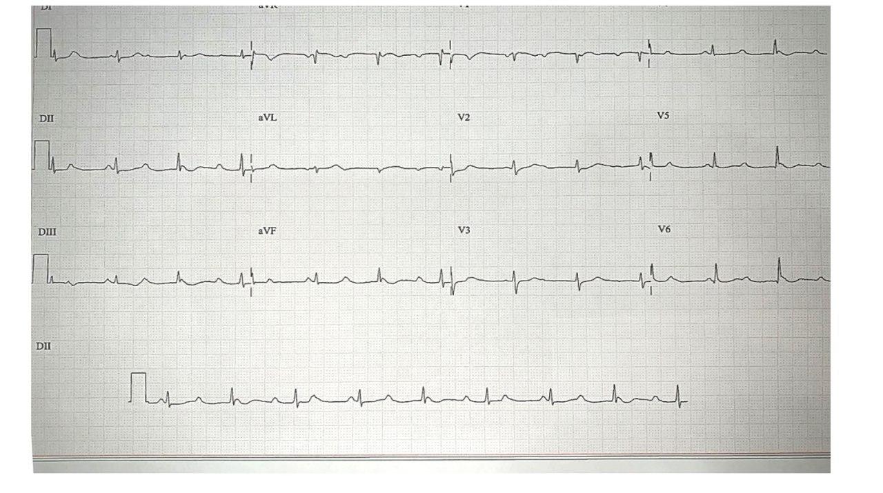 Mujer de 27 años, HTA leve y aumento del IMC que presenta BAVC congénito supraHis