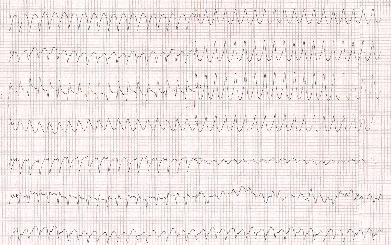 Mujer de 61 años que presenta dolor de pecho, disnea y sudoración por presencia de TV originada en aneurisma apical de etiología chagásica