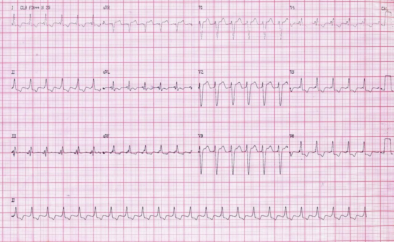 Hombre de 59 años hipertenso no controlado que presenta taquicardia de frecuencia aproximada a 150 lpm en la que el MSC permite diagnosticar como aleteo auricular 2:1