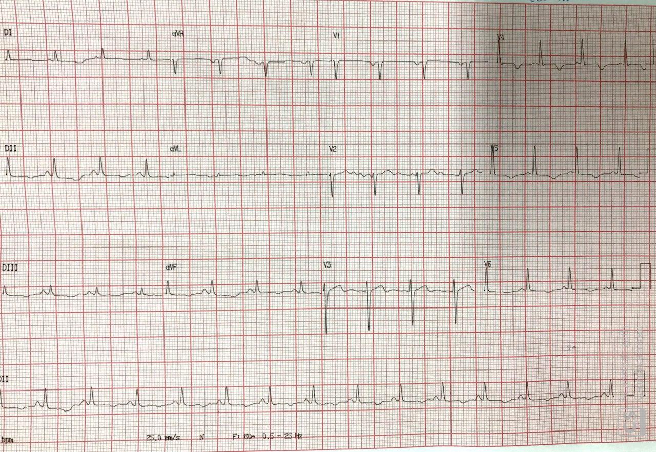 Mujer de 38 años con historia previa de IAM e implante de dos stents un año antes que presenta episodio de FV constatándose lesiones severas en ambos implantes y que a posteriori presenta espasmo coronario durante el sueño