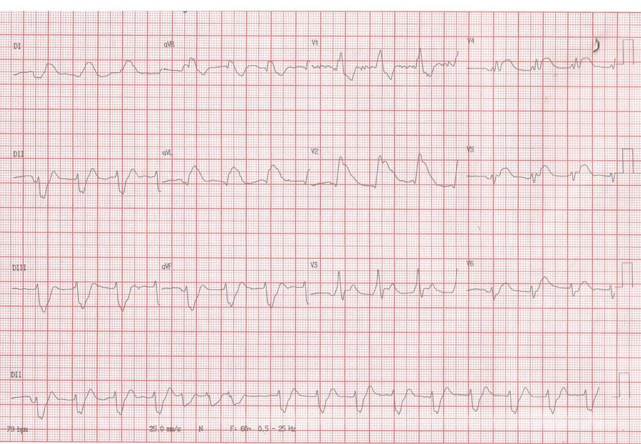 Hombre de 85 años con angor prolongado y evolución al shock cardiogénico debido a oclusión total de tronco de coronaria izquierda
