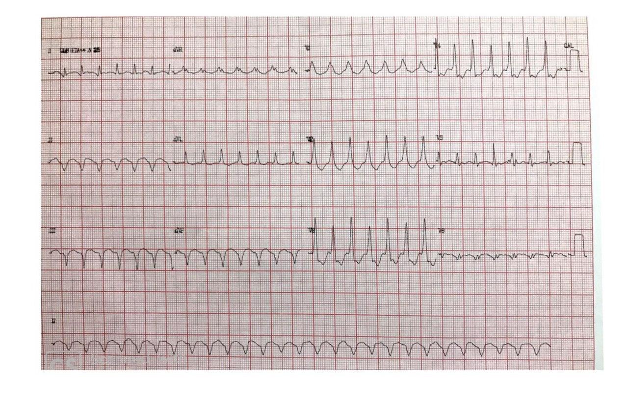 Paciente masculino de 61 años con antecedente inmediato de infarto agudo de miocardio hace una semana por oclusión total de CD, que presenta TV originada en la cicatriz necrótica