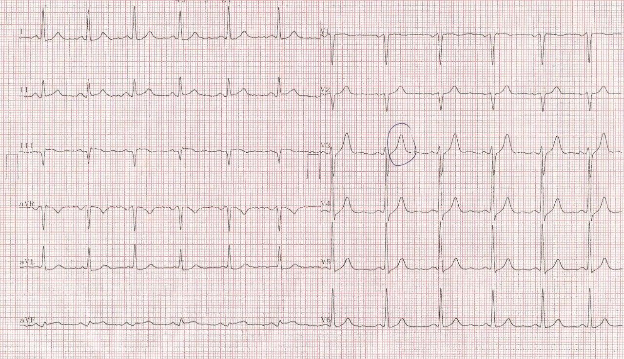 Hombre de 63 años con angor prolongado que evoluciona a IAM inferior por compromiso de CD proximal y lesiones en DA