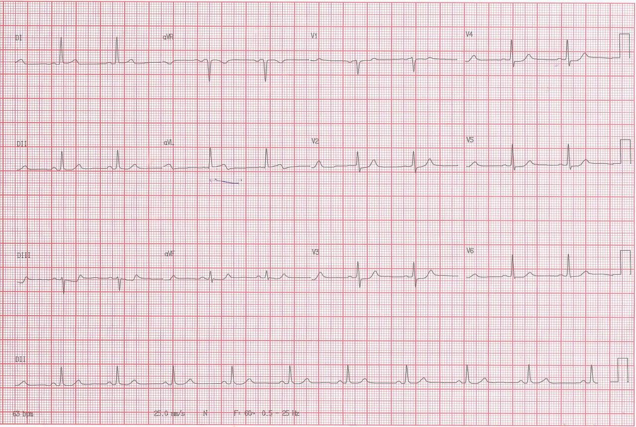 Mujer de 63 años portadora de enfermedad coronaria con angor actual por compromiso de la primera rama diagonal
