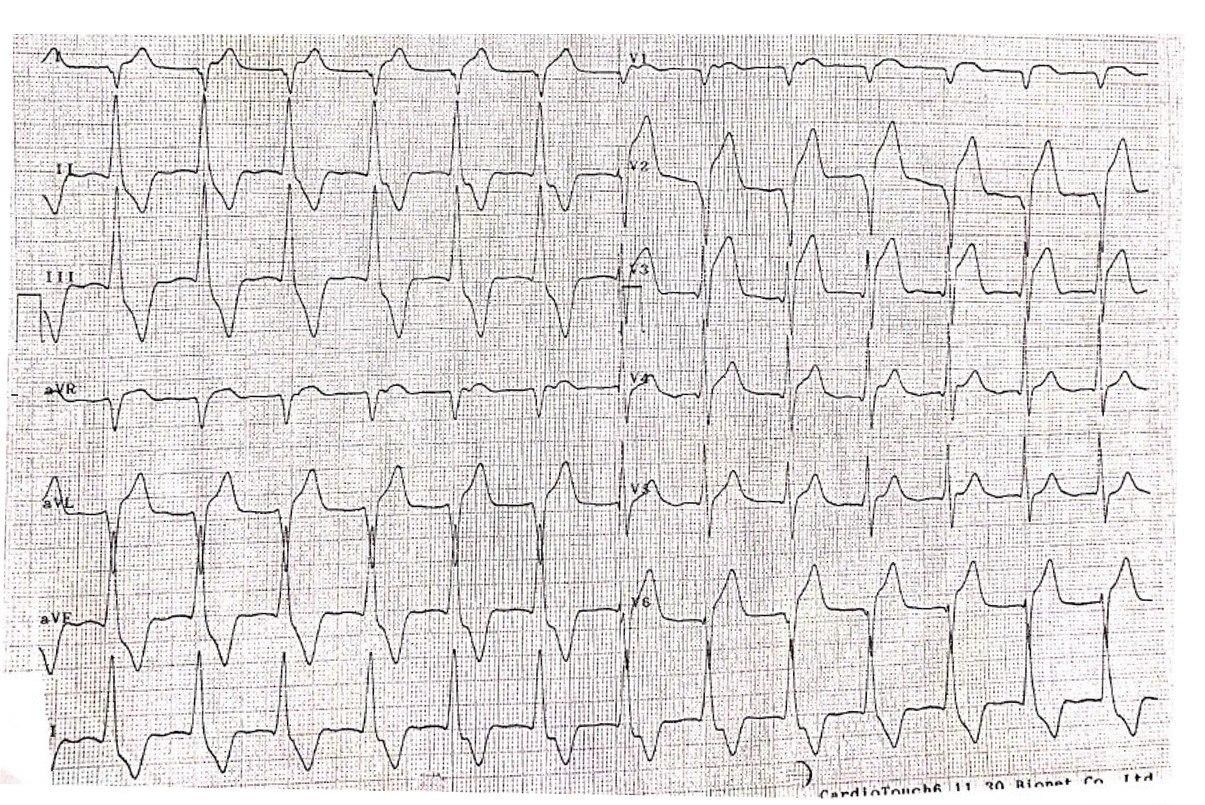 Hombre de 85 años con angor prolongado nocturno debido a suboclusión con trombo de DA con reperfusión espontánea parcial y detección de RIVA (ritmo idioventricular acelerado)