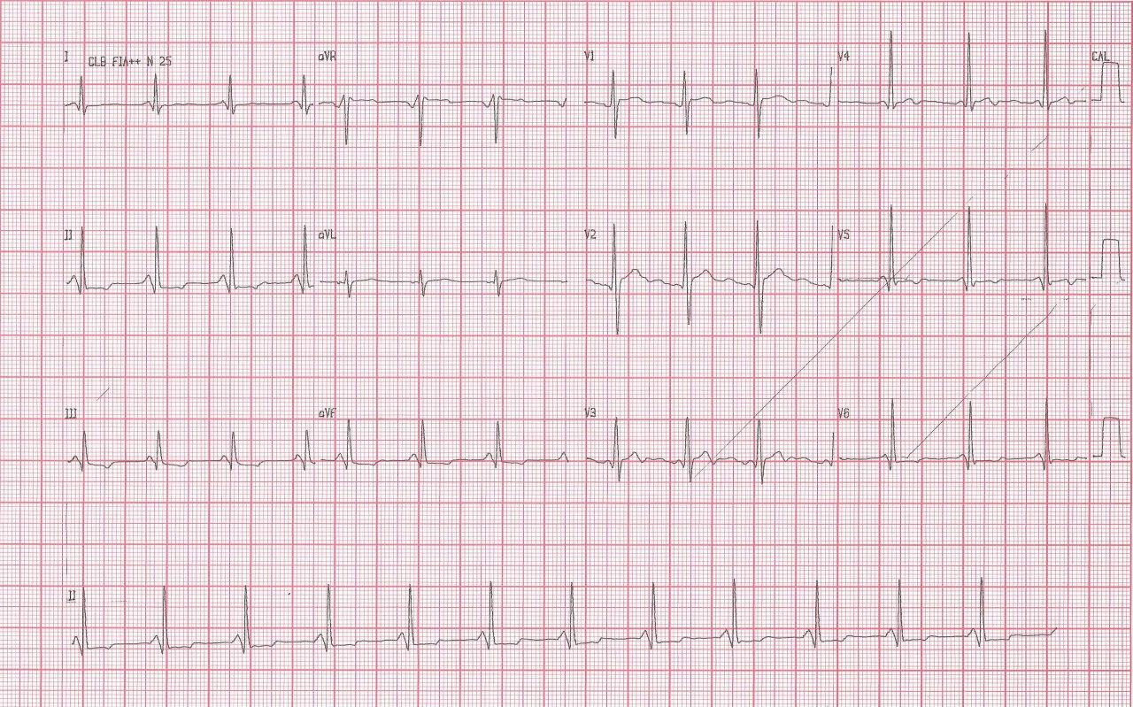 Hombre de 35 años con historia de palpitaciones, convulsiones y síncope que presenta PR corto por conducción nodal AV acelerada o síndrome de Lown Ganon Levine