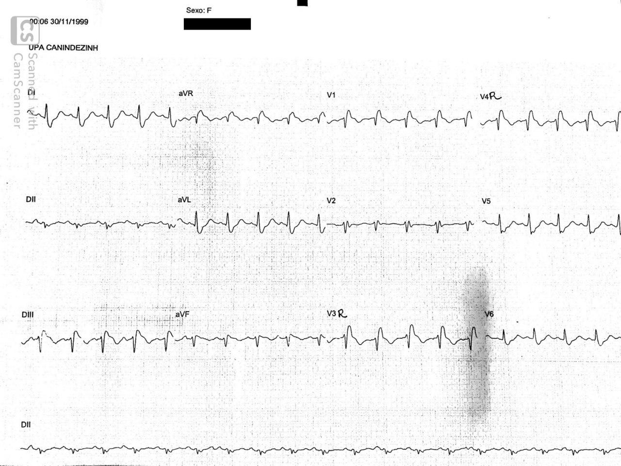Paciente de 48 años que presenta súbito dolor toráccico, relajación de esfínteres y síncope con presencia de BRD intermitente por presentar TEP bilateral con respuesta exitosa a la trombolisis