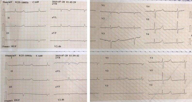 Hombre de 71 años portador de hepatopatía alcohólica e insuficiencia renal que cursa con hipocalcemia e hiperpotasemia cuyo ECG presenta QT largo