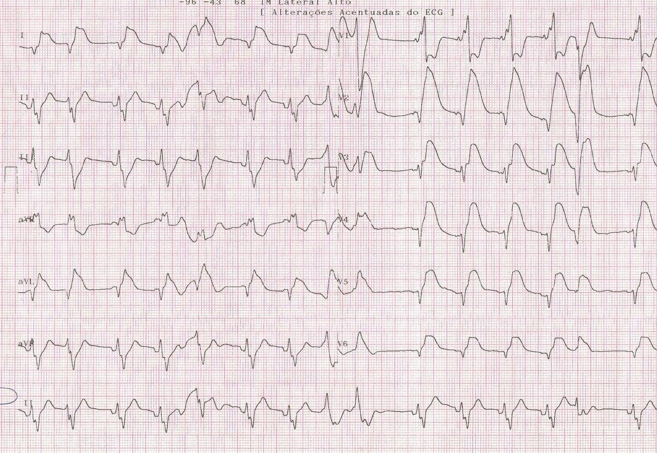Paciente masculino de 39 años que presenta brusco episodio de angor y síncope con evolución al shock cardiogenico irreversible por presencia de trombo en TCI y DA proximal