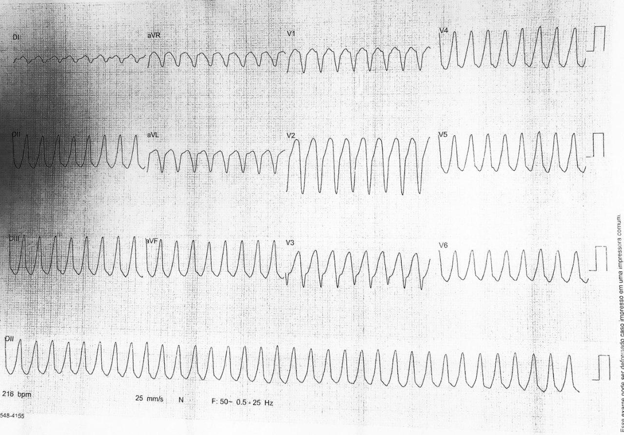 Paciente masculino que presenta somnolencia, sudoración e hipotensión por presencia de TV en contexto de SCA por oclusión total de DA y suboclusión de Mg de Cx con sospecha de trombo que migró desde el TCI